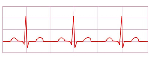 Caediogram